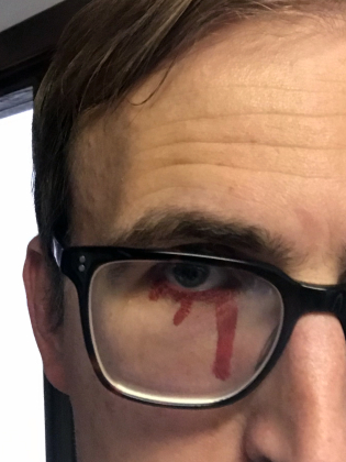 Närbild av vuxen man med mörka glasögon, kort brunt hår och röd vätska ritad under båda ögonen.